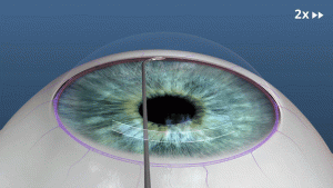 Cataract Surgery Devices Market