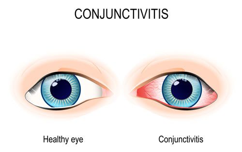 Conjunctivitis Treatment
