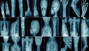 Medical X-Ray Market