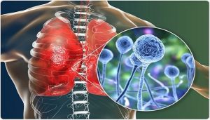 Mucormycosis Market