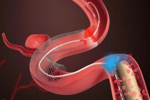 Neurovascular Stent Retrievers Market