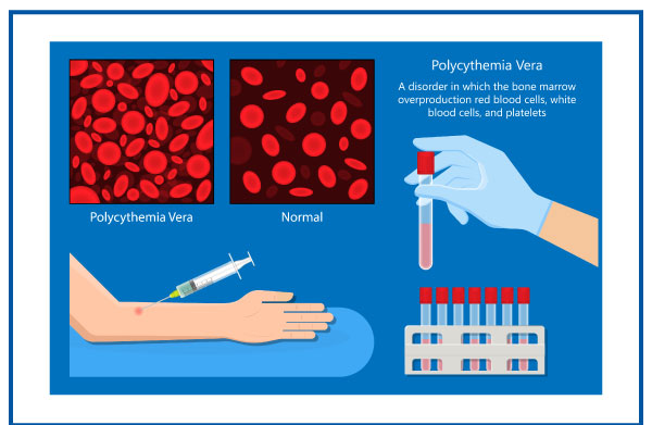 Recent Advancements in Polycythemia Vera Treatment Market: Opportunities and Challenges