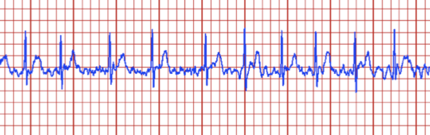 The incidence of atrial fibrillation is increasing, especially among the elderly population, due to factors such as an aging population, unhealthy lifestyles, and rising levels of obesity and cardiovascular disease