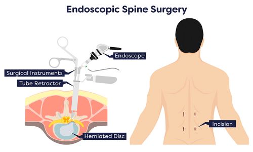Breaking Barriers in Spinal Care: How Endoscopic Spine Surgery is Changing the Game