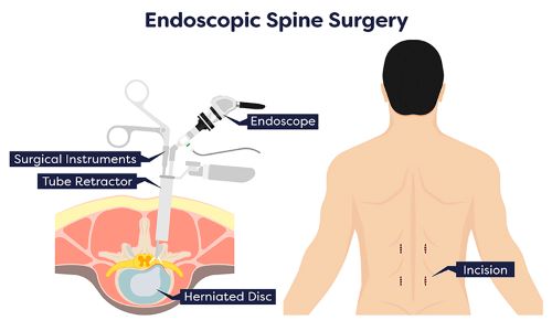 Endoscopic Spine Surgery