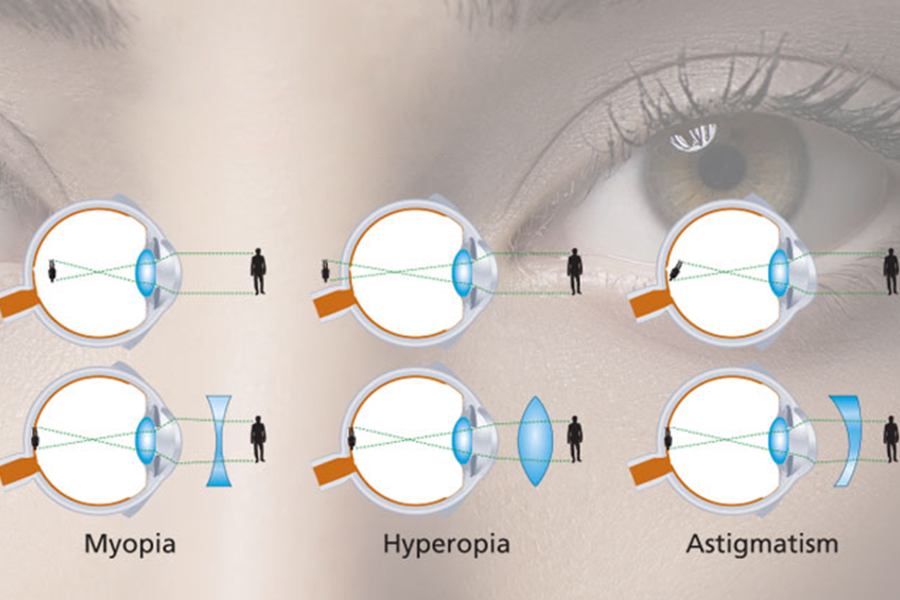From Glasses to Lasik: The Evolving Vision Correction Industry
