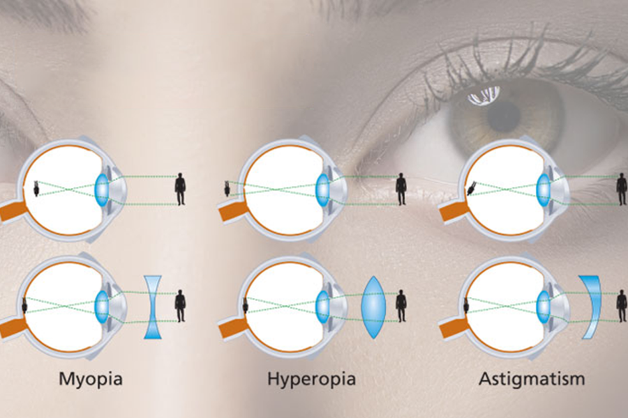 Vision Correction Market